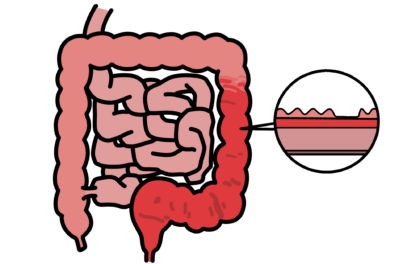 潰瘍性大腸炎イメージ