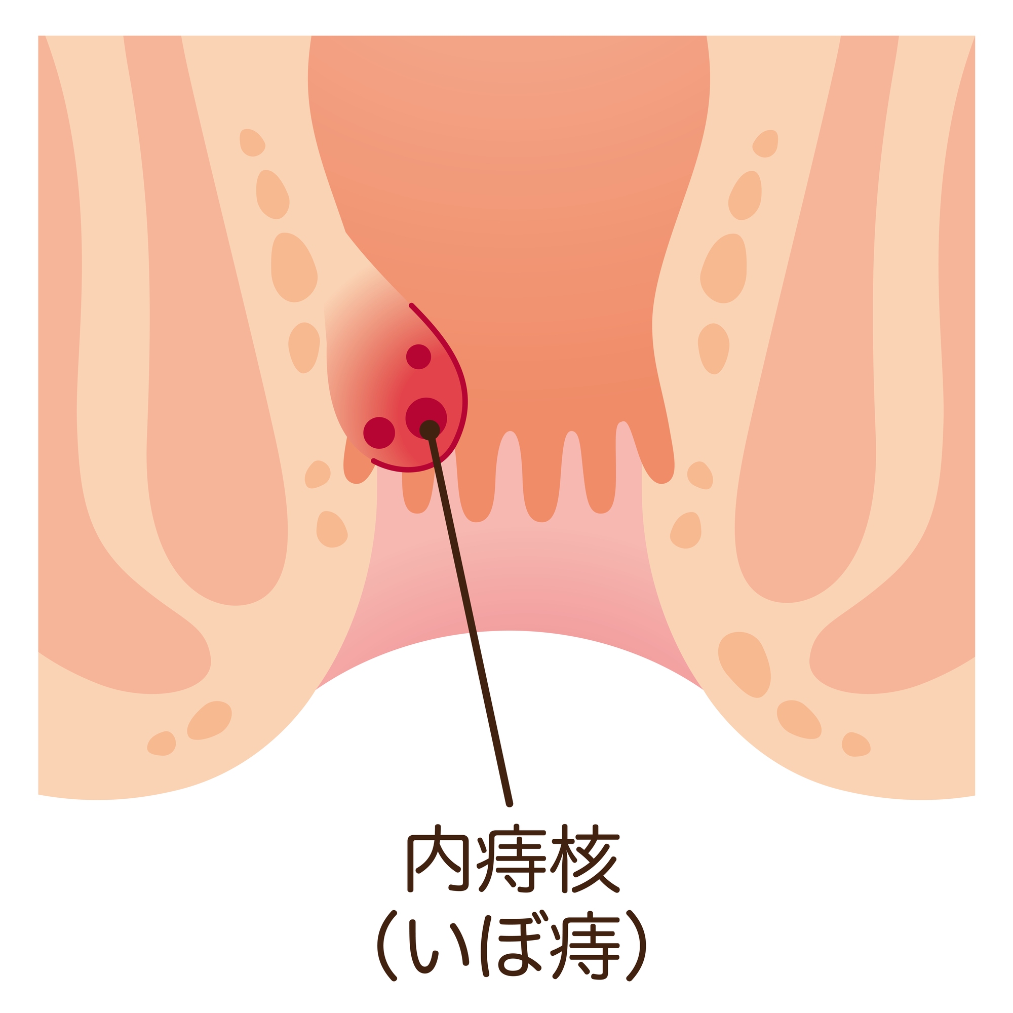 内痔核