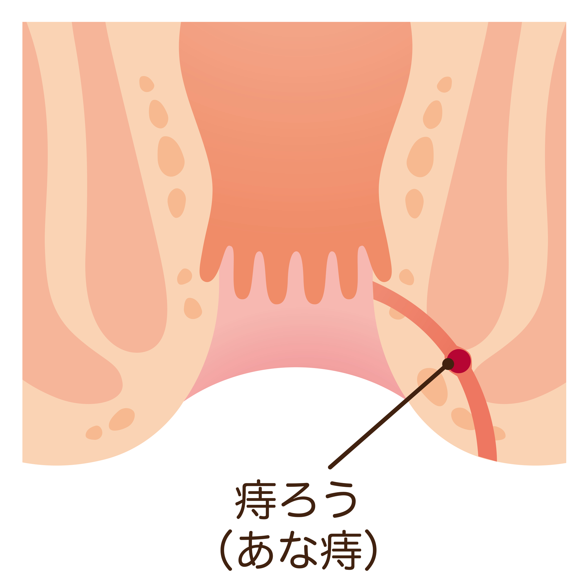 痔ろう