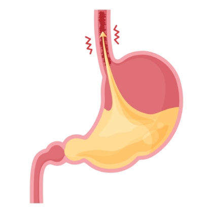 逆流性食道炎イメージ